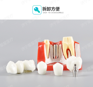 4 fois seul implant dentaire d'analyse modèle comparer avec pont logo OEM - Product Image 5