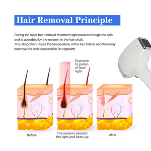 New Upgraded Dual Intelligent Ice Titanium soprano Diode Hair Removal Machine with 3-wavelength Customization - Product Image 3