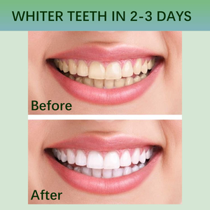 Bandes blanchissantes pour les dents 28 pièces Formule professionnelle à intensité professionnelle sans danger pour l'émail pour les taches de café avec traitement de réduction de la sensibilité - Product Image 5