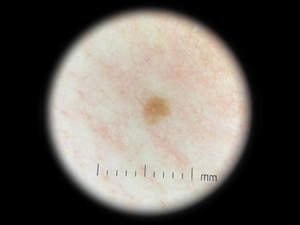 Iboolo de-phân 300 da tốt nhất mini máy ảnh dermatoscope thiết bị cho lâm sàng sử dụng bệnh viện sử dụng dermascopy - Product Image 5