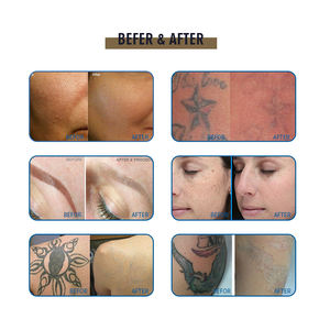 Machine de retrait de tatouage Laser picoseconde 2023 Laser Pico 1064 532 755nm q-switché nd yag machine laser - Product Image 6