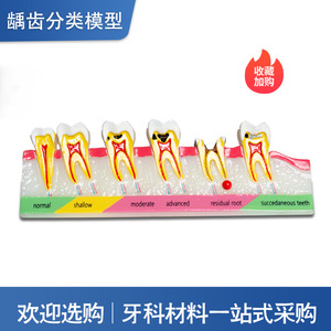 Modelo de Clasificación de Caries Dentales, Demostración de la Evolución de la Caries, Explicación de la Comunicación Médico-Paciente, Enseñanza Dental - Product Image 3