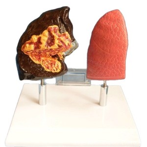 Modèle de comparaison des poumons sains et des poumons pathologiques ; Comparaison des poumons normaux et des poumons pathologiques ; Section anatomique de - Product Image 2