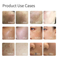 Nouvelle conception – Appareil de beauté de bureau électrique indolore pour le nettoyage du visage, stylo de cautérisation électrique pour l'élimination des excroissances cutanées et des taches, idéal pour les spas