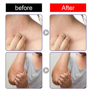 दक्षिण चंद्रमा का सबसे अच्छा हर्बल एंटी-बैक्टीरियल क्रीम माइली एंटी-खुजली से राहत - Product Image 6