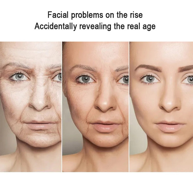RF Face Wrinkle Removal Machine