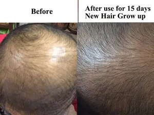 Wild Growth Hair Oil Rosemary Oil Hair Growth For Dry And Itchy Scalp