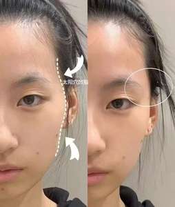 חומרי מילוי תת-עורית למקדשים, קפלי nasolabial וחדרי לחי - Product Image 4