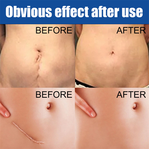 OEM Meilleure crème <span class=keywords><strong>pour</strong></span> l'élimination des cicatrices de brûlures d'acné Stria Gravidarum Chirurgical Pimple New Old Scar Removal Cream <span class=keywords><strong>pour</strong></span> enlever les cicatrices - Product Image 6