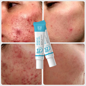 Meilleure crème <span class=keywords><strong>pour</strong></span> <span class=keywords><strong>les</strong></span> <span class=keywords><strong>boutons</strong></span> et <span class=keywords><strong>les</strong></span> taches sombres qui <span class=keywords><strong>les</strong></span> élimine et <span class=keywords><strong>les</strong></span> fait sécher, <span class=keywords><strong>pour</strong></span> <span class=keywords><strong>les</strong></span> femmes, crème séchante <span class=keywords><strong>pour</strong></span> <span class=keywords><strong>les</strong></span> <span class=keywords><strong>boutons</strong></span> - Product Image 1