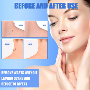 Crema OEM para el tratamiento de las verrugas, cuello, etiqueta para la piel, axila, verrugas planas, genitales, PIES, callos, crema, pomada para eliminar verrugas - Product Image 4