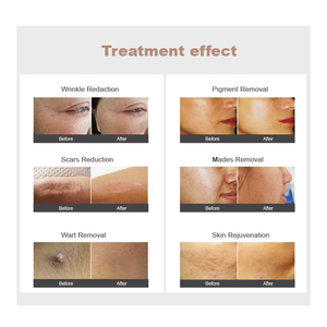 Clínica 10600nm Co2 Láser Fraccional Vulva Rejuvenecimiento Vaginal Estiramiento Eliminación de cicatrices CO2 LASER Equipo de salón de belleza - Product Image 2