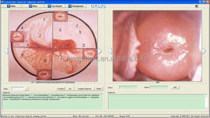 Vídeo Handheld Colposcópio Alta Qualidade Médica Digital Vagina Vídeo Colposcópio para Ginecologia - Product Image 6