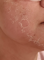 Kit de Récupération Cutanée ZS Spicules de Spongille Bio Microneedling Thérapeutique, Peeling aux Algues pour le Resurfaçage et l'Élimination des Taches, pour l'Hyperpigmentation
