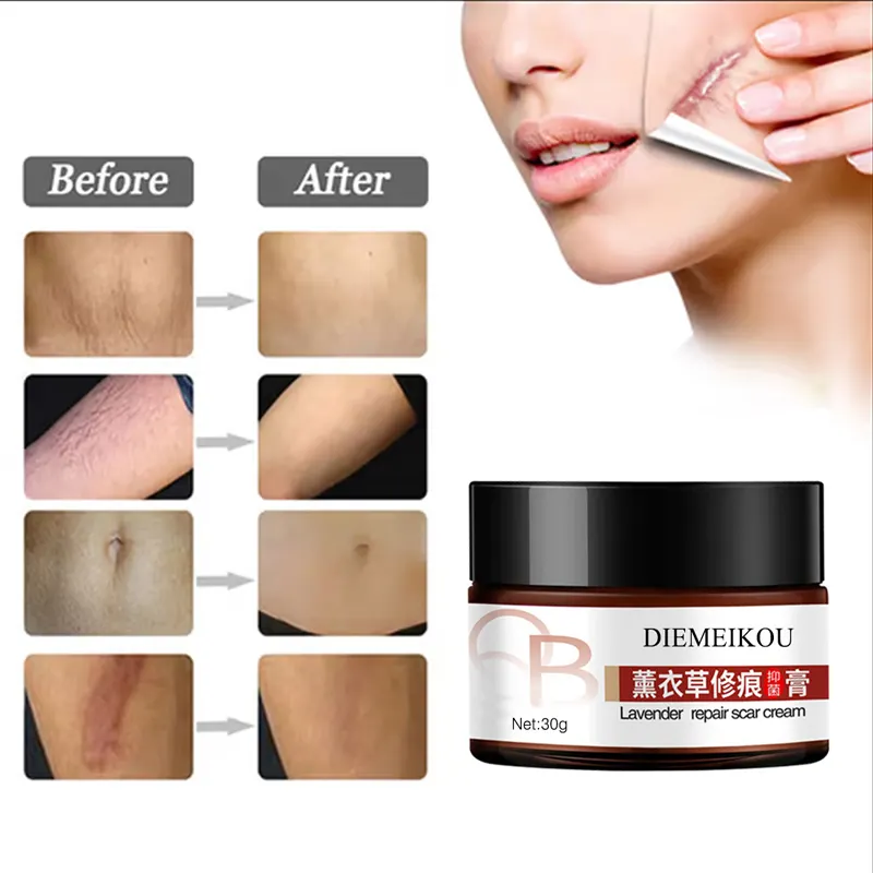 Wholesale high quality Stretch Marks Cream Acne Scar Repair Remover Cream For removal old scar mark 30ml