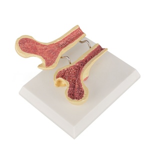Modèle de fémur ostéoporotique-Comparaison de la densité osseuse transversale pour l'enseignement orthopédique et l'éducation gériatique - Product Image 4