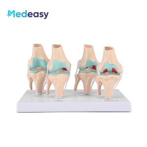 Levensgroot 4-fasen kniegewrichtsmodel Pathologisch anatomisch <span class=keywords><strong>model</strong></span> Schadewaardigheidsdemonstratiemodel Osteoartritismodel voor onderwijs - Product Image 1