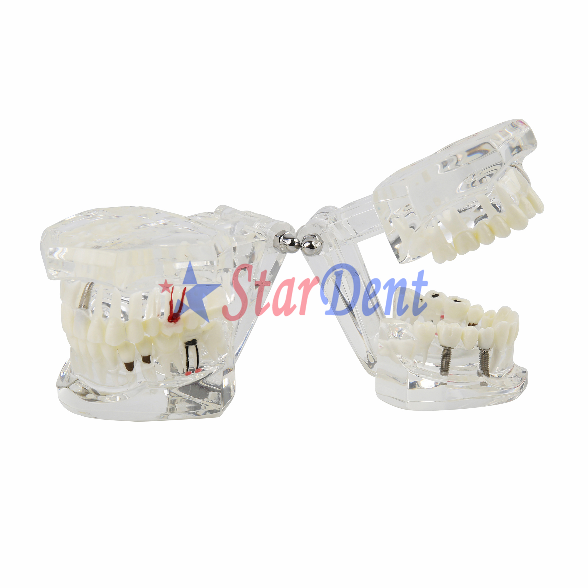 Dental Teeth Implant Model for Tooth Implant Practicing
