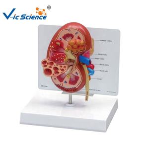 Modelo Anatómico de Riñón con Quiste Renal, Modelo de Anatomía Humana para Enseñanza Médica, Equipo de Patología Renal para Modelo de Quiste Renal - Product Image 2
