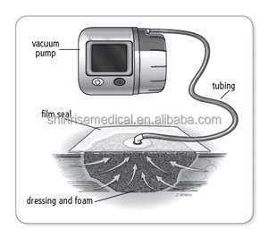 Kit di Medicazione Medica Monouso in Schiuma PU per Terapia a Pressione Negativa (NPWT) Certificato CE EO - Product Image 5