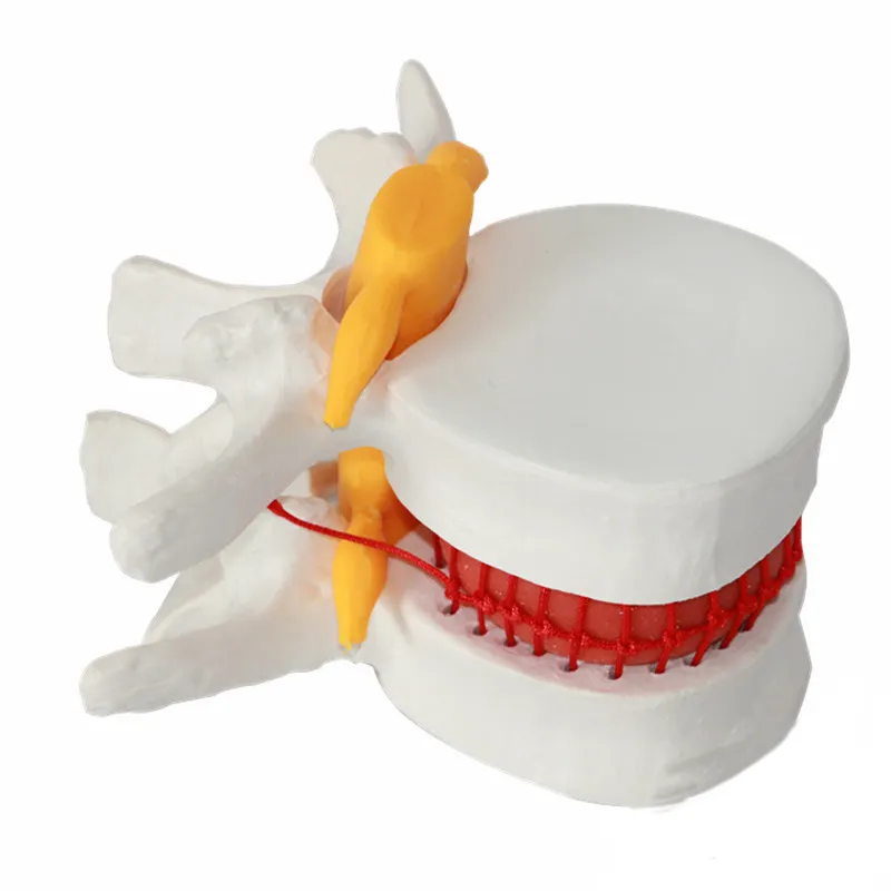 Destekli öğretim gösteri modeli lomber disk hernisi modeli intervertebral disk modeli