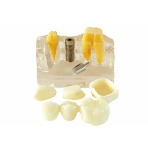 Dental 4 Times Implant Model Implant Crown and Bridge Model Transparent