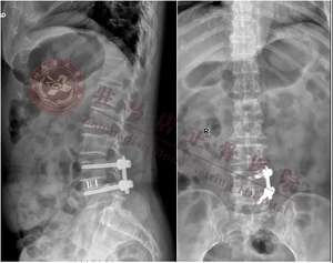 Instrumentos Cirúrgicos de Aço Inoxidável OLIF da Beijing Fule Orthopedic <span class=keywords><strong>Medical</strong></span> <span class=keywords><strong>Instruments</strong></span> - Product Image 6