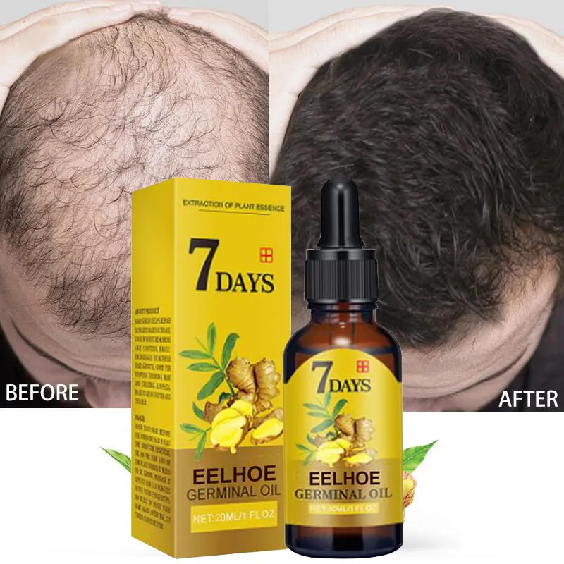 Óleo de essência para crescimento de cabelo, 7 dias, rápido, tratamento para perda de cabelo, óleo essencial para cuidado com o cabelo