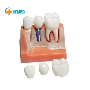 Dental Implant Model for Patient Education 4 Times Dental Implant Crown and Bridge Model for Presentation-Pink