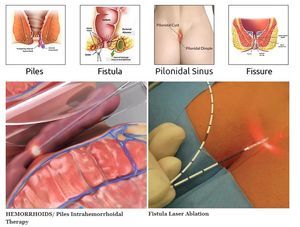 Máquina Quirúrgica Láser de Clase 4 para Tratamiento de Hemorroides, 980nm 1470nm LHP, Fisura, Fístula, Proctología Anal, Intravenosa, Urología - Product Image 3