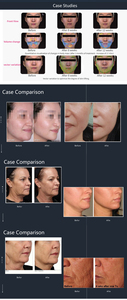 Appareil de soin vertical multi-sondes pour le visage, exfoliant et liftant, anti-âge - Product Image 4