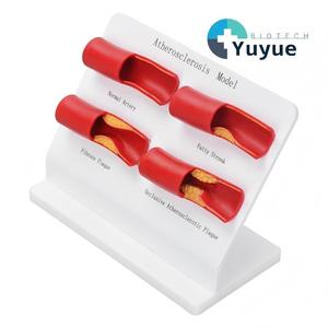 Modelo de Aterosclerosis, Juego de Modelos de Arterias, Progresión de Enfermedades Vasculares en 4 Etapas, Modelo Anatómico para Enseñanza Médica - Product Image 1