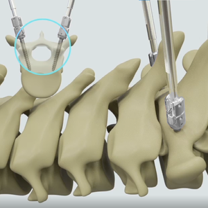 Hoogwaardige titanium implanteerbare kunstorganen COX II voor wervelkolomchirurgie, medisch hulpmiddel klasse III - Product Image 3
