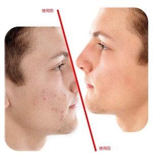 Cerotti per Brufoli Hysent, 24 <span class=keywords><strong>Punti</strong></span>, Cerotti Idrocolloidali Impermeabili a Forma di Stella Nera per la Cura del Viso e l'Eliminazione dell'Acne - Product Image 5