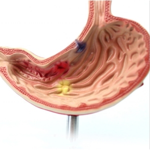 Nhà máy PVC giải phẫu mô hình cho dạ dày bệnh lý thủng và loét phần tăng cường thông tin liên lạc giảm Giải Thích - Product Image 2