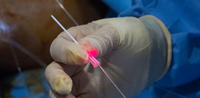 Fibre médicale Arfurla pour varices, fibre radiale EVLT