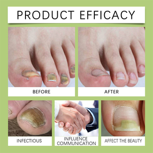 Ximonth 30ml Liquide de Soin des Ongles Contre les Mycoses avec Lime – Réduit l'Inconfort des Ongles des Pieds, Restaure la Santé et Nourrit les Ongles - Product Image 3
