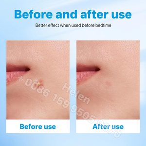 24PCS trong suốt bướm Hydrocolloid mụn các bản vá lỗi tùy chỉnh Công thức với axit salicylic & dầu cây trà mụn Zit bao gồm - Product Image 5