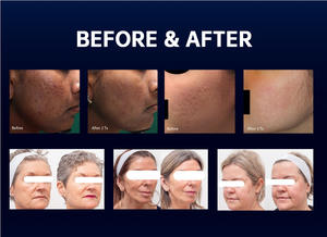 Máquina Láser <span class=keywords><strong>de</strong></span> Tulio ThuliWave Medical No Ablativa <span class=keywords><strong>de</strong></span> 1927nm con Enfriamiento por <span class=keywords><strong>Agua</strong></span>/Aire para Lifting Facial, Cuidado del Cuero Cabelludo y Terapia <span class=keywords><strong>de</strong></span> Crecimiento Capilar - Product Image 2