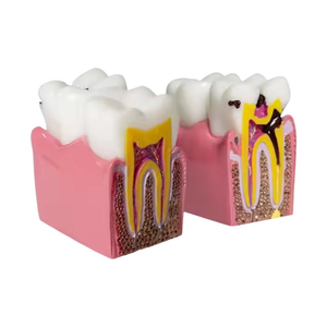 Modello Comparativo di Denti con 6 Volte Più Danni, Modello di Denti in Resina Dentale Smontabile - Product Image 3