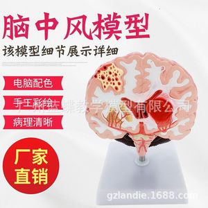 Anatomía del cerebro humano; modelo de cerebro/ictus; modelo de enfermedad cerebral; hemorragia cerebral; modelo anatómico de lesiones cerebrales. - Product Image 5