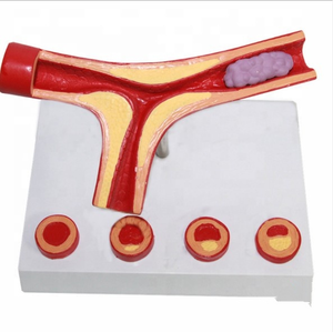 Science médicale de haute qualité et meilleur prix, modèle de <span class=keywords><strong>pathologie</strong></span> de vaisseau sanguin de trombose - Product Image 3