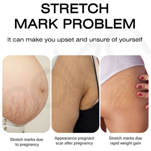 Crema Facial Efectiva <span class=keywords><strong>para</strong></span> Eliminar Cicatrices, Acné, Espinillas y Estrías, Crema Reparadora de Piel Reafirmante y Suavizante - Product Image 3