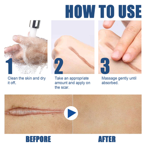 OEM Meilleure crème <span class=keywords><strong>pour</strong></span> l'élimination des cicatrices de brûlures d'acné Stria Gravidarum Chirurgical Pimple New Old Scar Removal Cream <span class=keywords><strong>pour</strong></span> enlever les cicatrices - Product Image 4