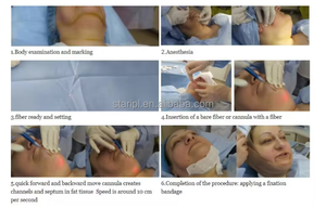Machine portative de beauté de laser de 2025 diode 1470nm 980nm pour Endolaser de thérapie de <span class=keywords><strong>clinique</strong></span> de lifting et de réduction de graisse - Product Image 2