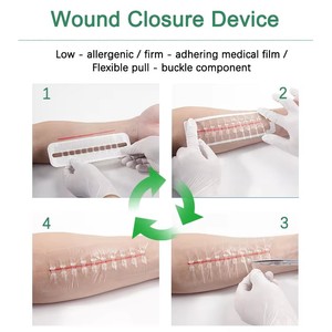 Fermeture éclair médicale à 10 boutons en film PU pour incisions chirurgicales et traumatiques, y compris les césariennes - Product Image 5