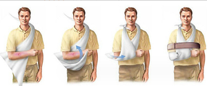 Benda Triangolare in Cotone Medresq per Fissaggio Arti, Pronto Soccorso, Emergenze e Campeggio - Product Image 5