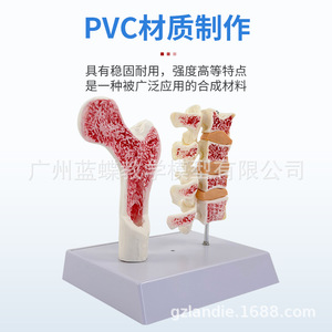Modèle anatomique d'ostéoporose fémorale humaine, surface anatomique de l'os de la jambe, spécimen de section vertébrale, vertèbre lombaire malade - Product Image 1