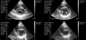 Konted MDR mesin <span class=keywords><strong>Ultrasound</strong></span> nirkabel, pemindai <span class=keywords><strong>Ultrasound</strong></span> nirkabel teknologi tinggi untuk jantung/Hati - Product Image 6