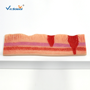 Modèle d'ulcère gastrique et de perforation : Montre l'évolution de la gastrite à l'ulcère perforant pour l'enseignement médical et la formation en pathologie - Product Image 5